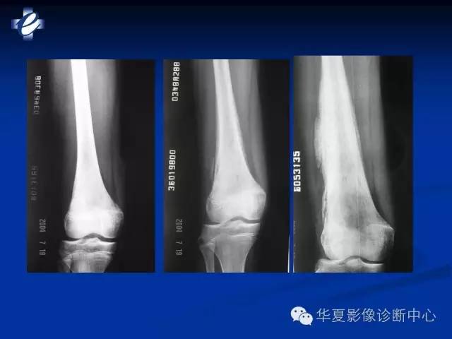 【PPT】骨与关节感染的影像学诊断