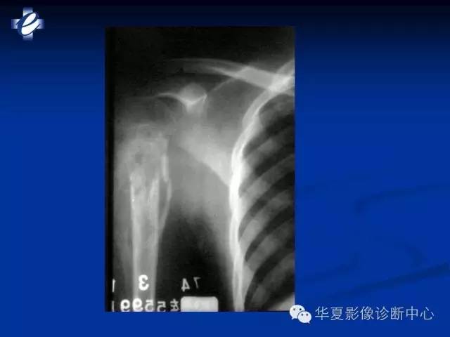 【PPT】骨与关节感染的影像学诊断