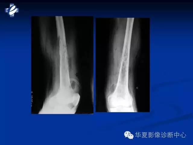 【PPT】骨与关节感染的影像学诊断
