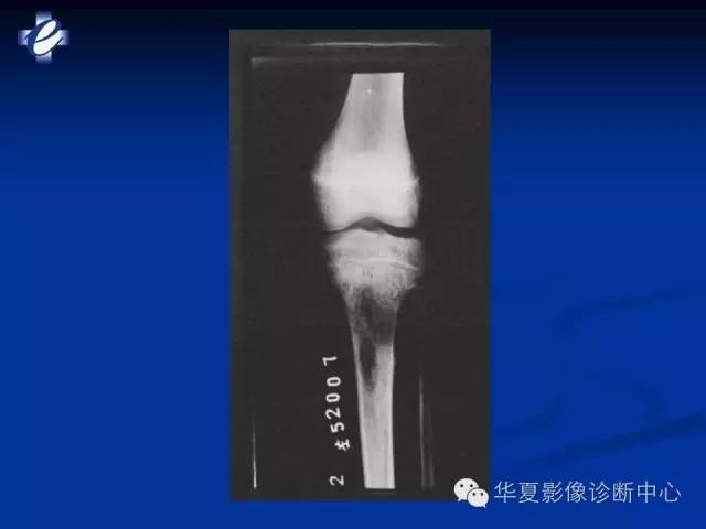 【PPT】骨与关节感染的影像学诊断