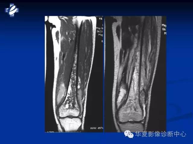 【PPT】骨与关节感染的影像学诊断