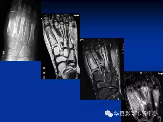 【PPT】骨与关节感染的影像学诊断