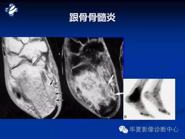 【PPT】骨与关节感染的影像学诊断