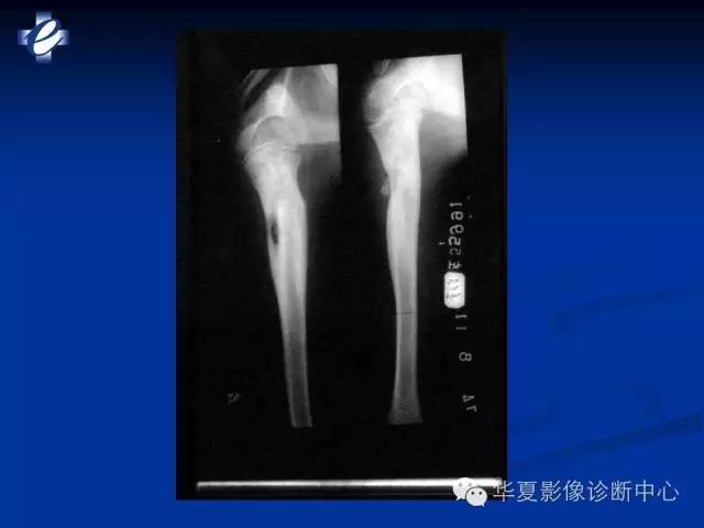 【PPT】骨与关节感染的影像学诊断