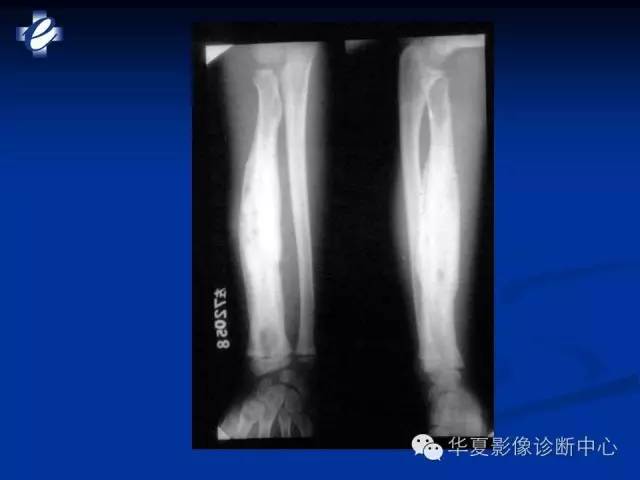 【PPT】骨与关节感染的影像学诊断