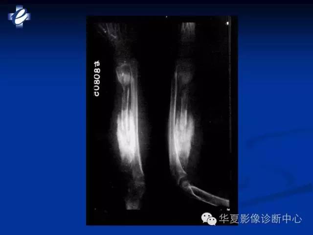 【PPT】骨与关节感染的影像学诊断