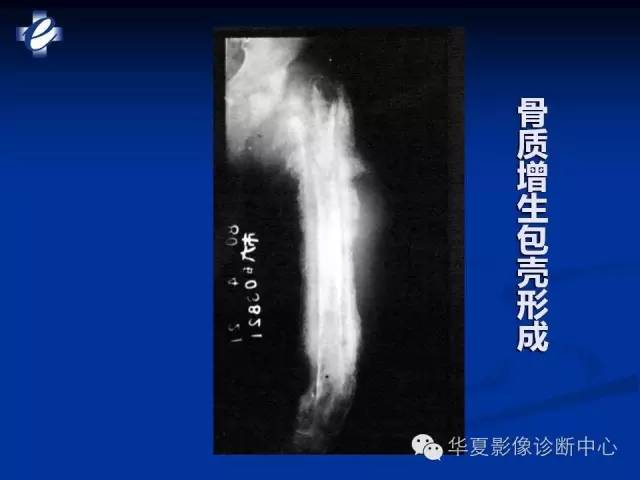 【PPT】骨与关节感染的影像学诊断