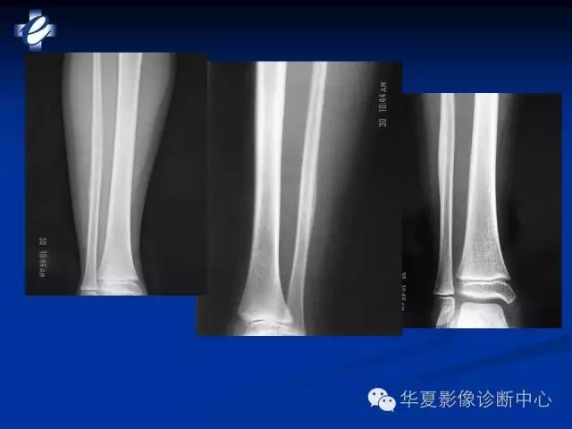 【PPT】骨与关节感染的影像学诊断