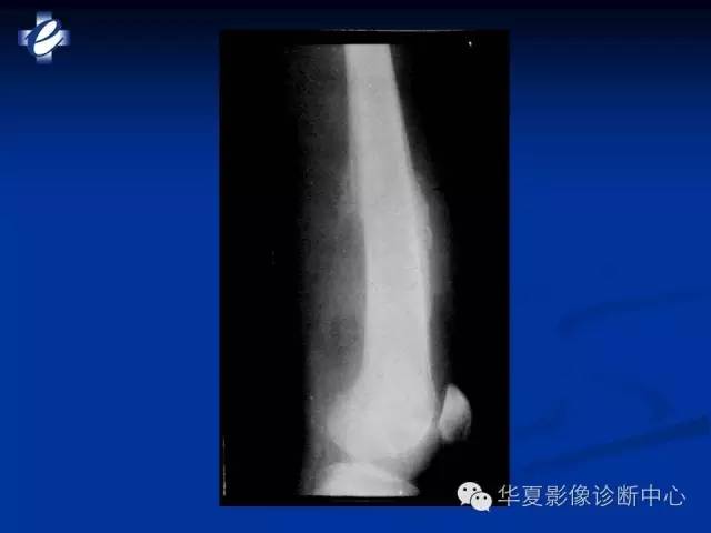 【PPT】骨与关节感染的影像学诊断