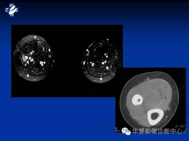 【PPT】骨与关节感染的影像学诊断