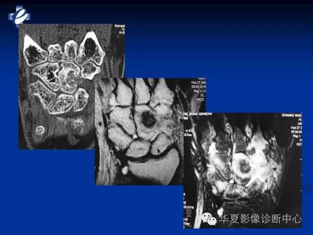 【PPT】骨与关节感染的影像学诊断