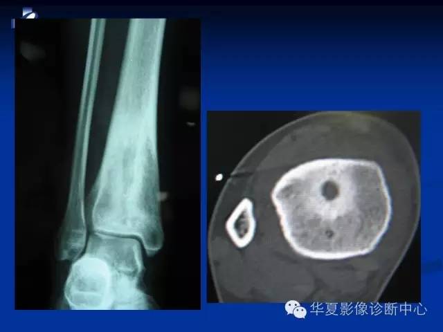 【PPT】骨与关节感染的影像学诊断