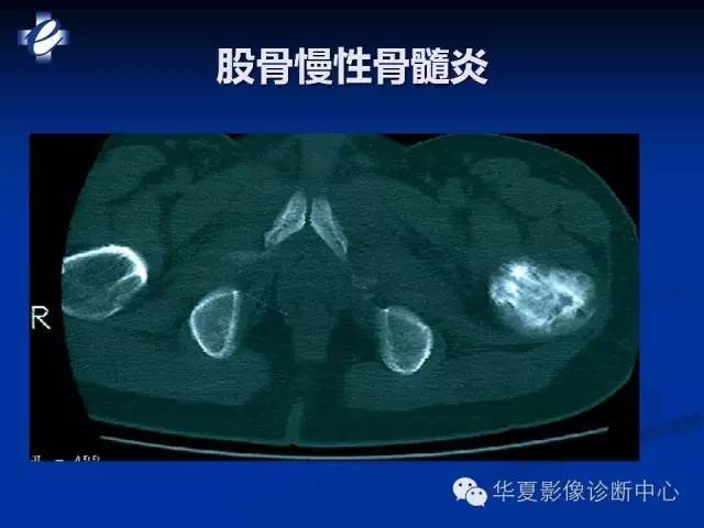【PPT】骨与关节感染的影像学诊断