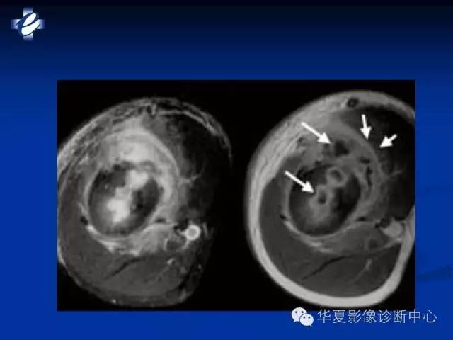 【PPT】骨与关节感染的影像学诊断