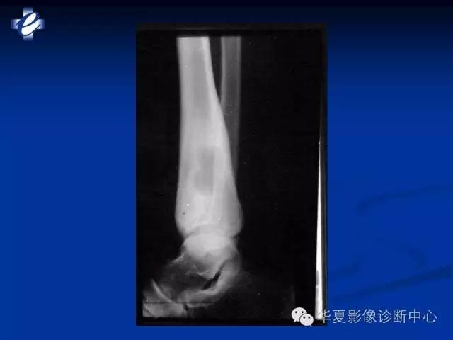 【PPT】骨与关节感染的影像学诊断
