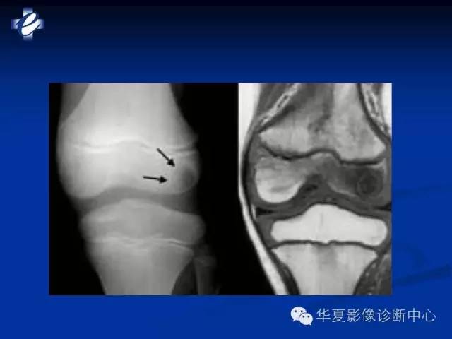 【PPT】骨与关节感染的影像学诊断