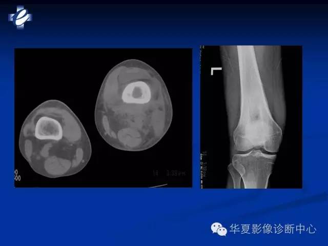 【PPT】骨与关节感染的影像学诊断