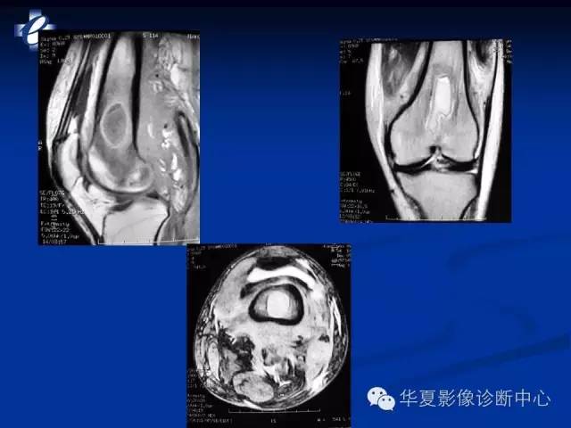 【PPT】骨与关节感染的影像学诊断