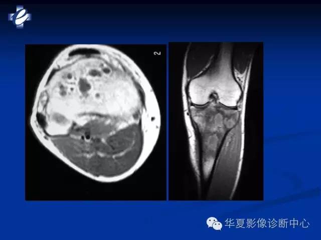 【PPT】骨与关节感染的影像学诊断