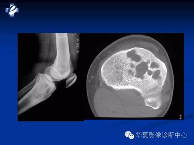 【PPT】骨与关节感染的影像学诊断