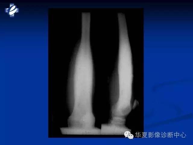 【PPT】骨与关节感染的影像学诊断