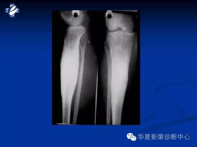 【PPT】骨与关节感染的影像学诊断