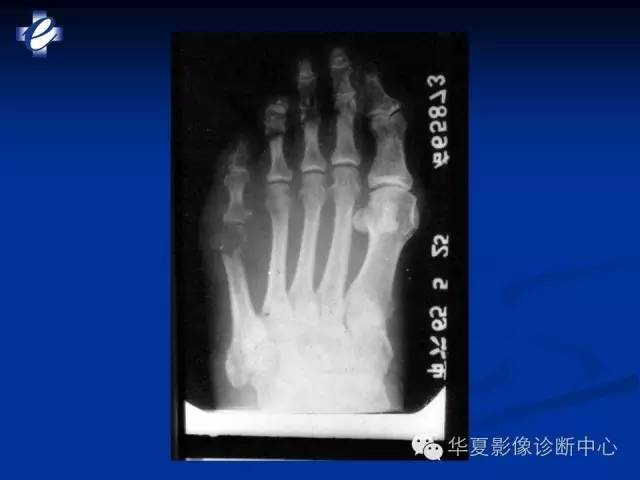 【PPT】骨与关节感染的影像学诊断