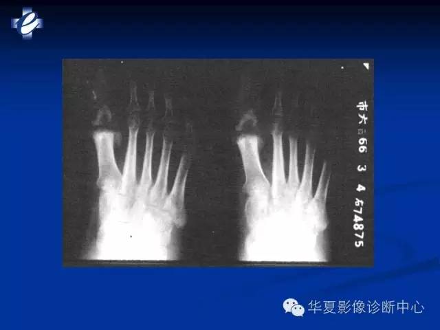 【PPT】骨与关节感染的影像学诊断