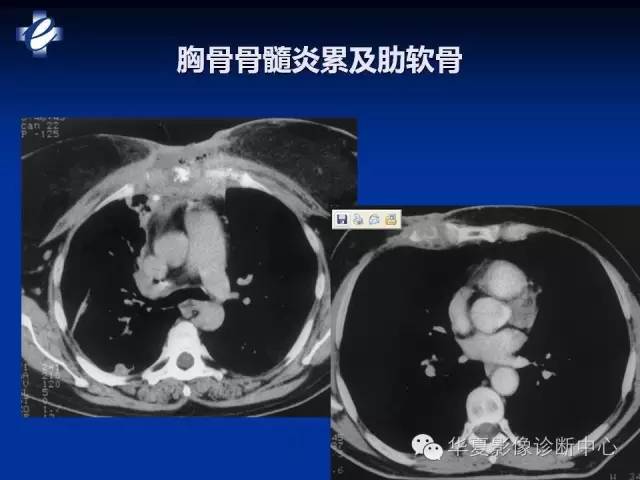 【PPT】骨与关节感染的影像学诊断