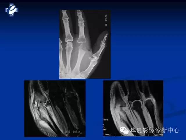 【PPT】骨与关节感染的影像学诊断