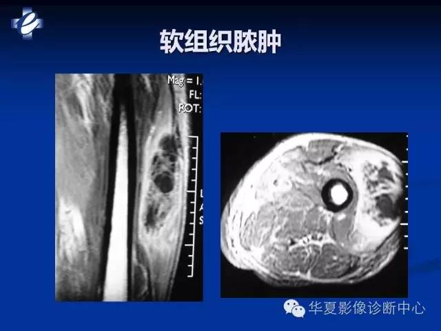 【PPT】骨与关节感染的影像学诊断