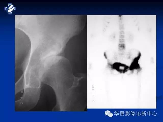 【PPT】骨与关节感染的影像学诊断