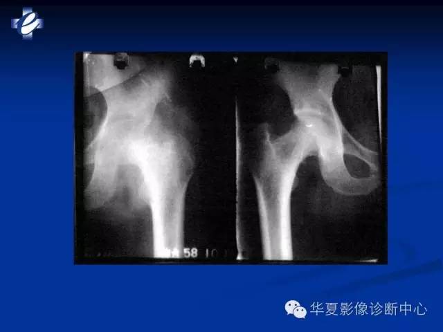 【PPT】骨与关节感染的影像学诊断