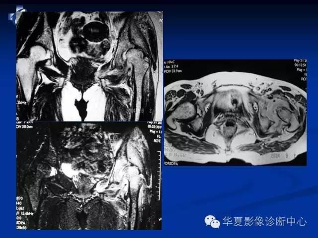 【PPT】骨与关节感染的影像学诊断