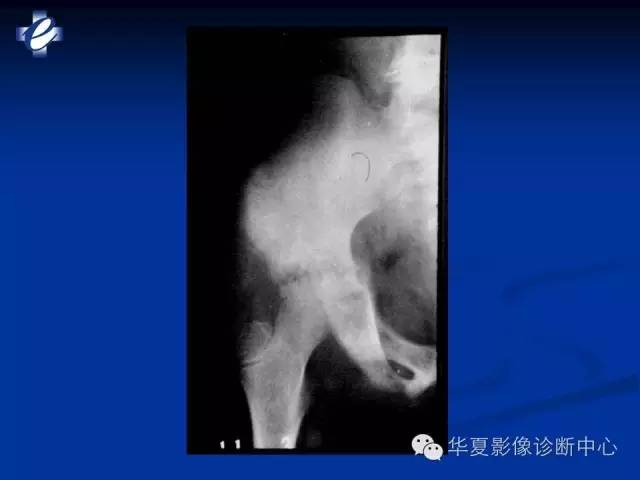 【PPT】骨与关节感染的影像学诊断