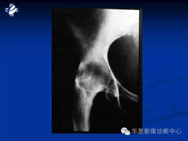 【PPT】骨与关节感染的影像学诊断