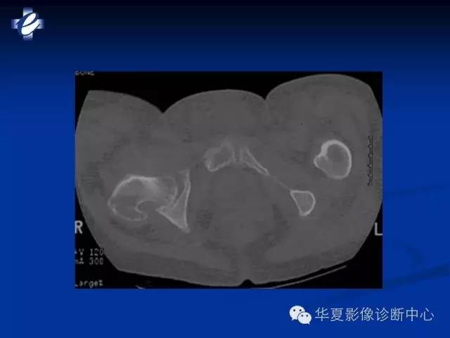 【PPT】骨与关节感染的影像学诊断