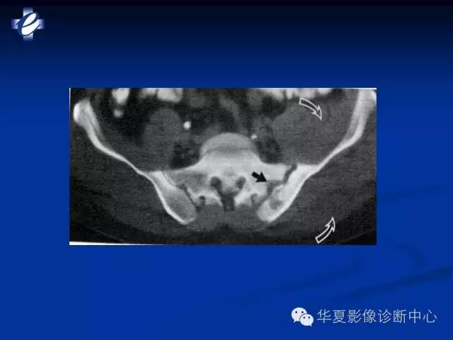 【PPT】骨与关节感染的影像学诊断
