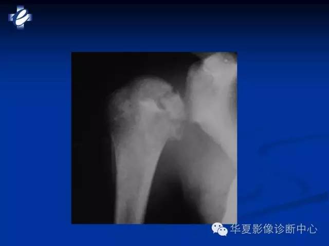 【PPT】骨与关节感染的影像学诊断