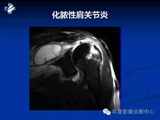 【PPT】骨与关节感染的影像学诊断