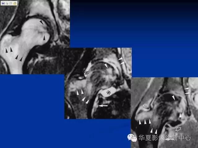 【PPT】骨与关节感染的影像学诊断