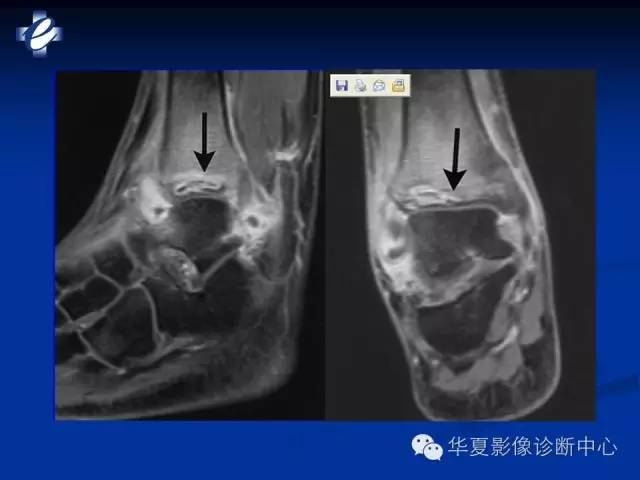 【PPT】骨与关节感染的影像学诊断