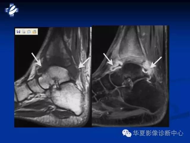 【PPT】骨与关节感染的影像学诊断