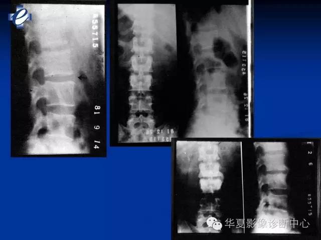 【PPT】骨与关节感染的影像学诊断