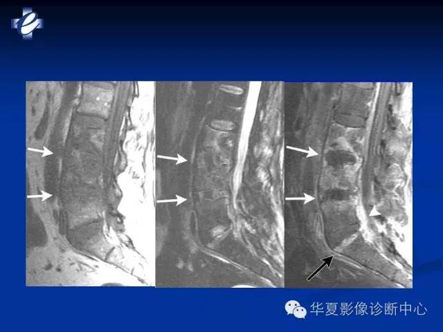 【PPT】骨与关节感染的影像学诊断