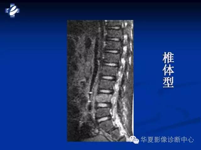 【PPT】骨与关节感染的影像学诊断