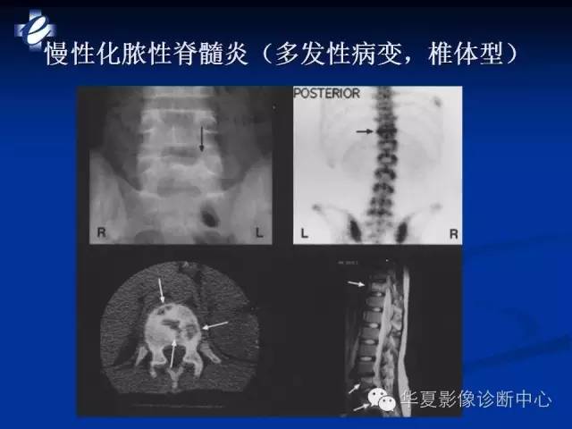 【PPT】骨与关节感染的影像学诊断