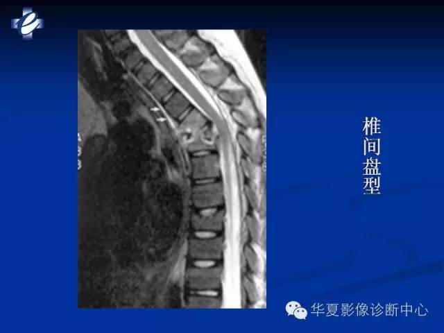 【PPT】骨与关节感染的影像学诊断