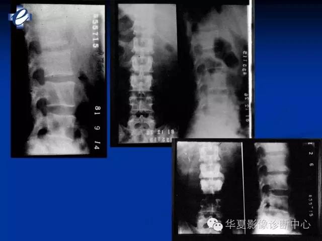 【PPT】骨与关节感染的影像学诊断