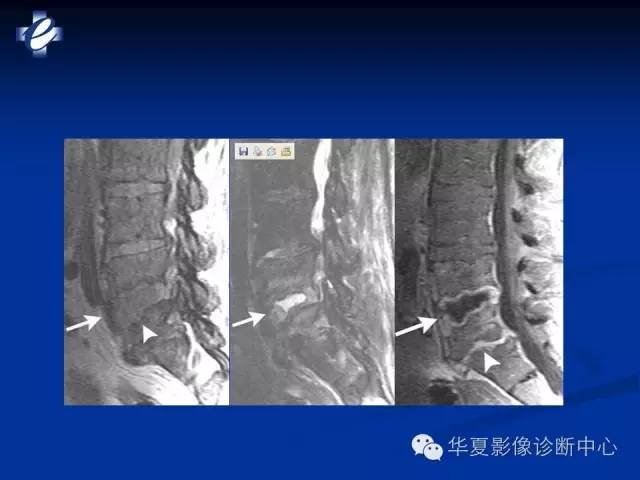 【PPT】骨与关节感染的影像学诊断